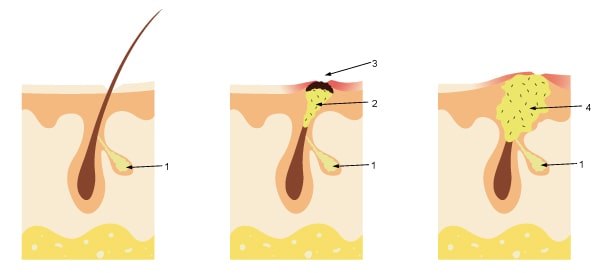 How does acne occur